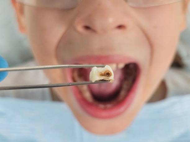 Best Emergency Tooth Extraction in Tinley Park, IL
